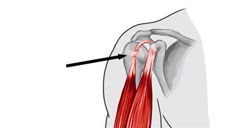 biceps long head tear test|rupture of long head bicep.